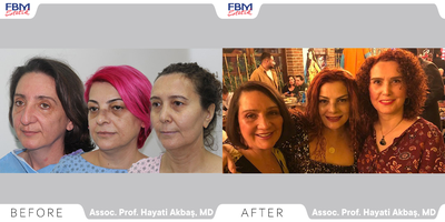 45-54 year old woman treated with Deep Plane Facelift, Neck Lift, Rhinoplasty, Facial Fat Transfer - Three friends had the same procedures Deep plane face -neck lift and rejuvenation procedures, Rhinoplasty surgery (two of them).After one year of the surgery.