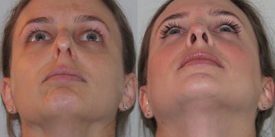 25-34 year old woman treated with Sinus Surgery - Long time sufferer from breathing issues stemming from untreated broken nose, severe deviated septum and collapse nasal valve.