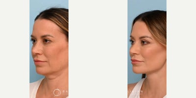 Woman treated with Facelift, Deep Plane Facelift, Neck Lift, Brow Lift, Eyelid Surgery, CO2 Laser - Woman treated with Facelift, Deep Plane Facelift, Neck Lift, Brow Lift, Eyelid Surgery, CO2 Laser