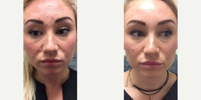 25-34 year old woman treated with Skin Lightening - Treated with laser Skin Rejuvenation.
