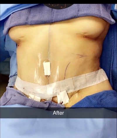 The Skinny On The Skinny Tummy Tuck - Frank Agullo, MD