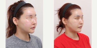 25-34 year old woman treated with AccuLift, Liposuction - 33 Years old female patientChief Complaint:Facial puffiness and uneven contour, especially in the lower cheeks and jawline.Treatment Plan:Facial liposuction focusing on lower cheeks and jawline refinement.Outcome:Slimmer, more defined facial contour with reduced puffiness and improved facial balance.