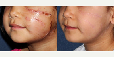Child treated with Active/Deep FX - Active/Deep FX laser treatment is used to reduce the appearance of facial damage to a young child.
