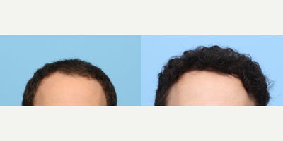 18-24 year old man treated with FUE Hair Transplant, Hair Transplant, Hair Loss Treatment, PRP for Hair Loss, PRP Injections - Remarkable hair restoration results one year after a 2,525 graft FUE hair transplant to Zone 1, performed by Dr. Wise, complemented by a PRP therapy session. This 22-year-old patient achieved a natural and fuller hairline, enhancing both appearance and confidence.