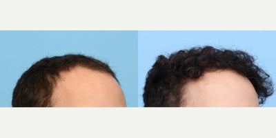 18-24 year old man treated with FUE Hair Transplant, Hair Transplant, Hair Loss Treatment, PRP for Hair Loss, PRP Injections - Remarkable hair restoration results one year after a 2,525 graft FUE hair transplant to Zone 1, performed by Dr. Wise, complemented by a PRP therapy session. This 22-year-old patient achieved a natural and fuller hairline, enhancing both appearance and confidence.