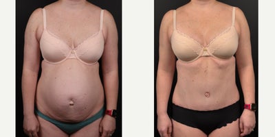35-44 year old woman treated with Tummy Tuck, Diastasis Recti Repair, Umbilical Hernia Repair, Liposuction - This 38 year old woman is 5'3 and 138 pounds. She has been pregnant 5 times, had 4 children, 3 of them by C-section. She has a wide diastasis recti, (separation of the abdominal muscles), and even ventral and umbilical hernias. She had an abdominoplasty with repair of rectus diastasis and hernias, as well as some liposuction of the flanks.