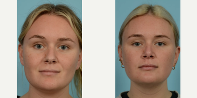Woman treated with Revision Rhinoplasty - Woman treated with Revision Rhinoplasty