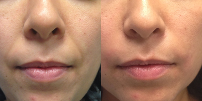 25-34 year old woman treated with Radiesse - One tube 1.5 cc radiesse used to help fill nasolabial folds