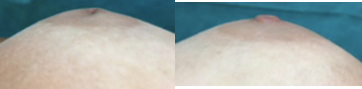 18-24 year old woman treated with Inverted Nipple Surgery - Inverted nipple surgery under local anesthesia