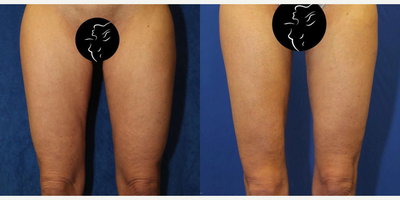 35-44 year old woman treated with Thigh Lift - This is a 41 year old female patient who was unhappy with the shape of their thighs. They maintained a healthy diet and exercised regularly, however, the patient still felt very self conscious about their thighs appearance. Due to the patients age and skin elasticity, they had excess skin and fat of the inner thigh from the groin to the knee. So, the patient underwent a bilateral vertical medial thigh reduction with thigh liposuction. The procedure was performed under general anesthesia with a board-certified anesthesiologist. The bilateral vertical medial thigh reduction took approximately 4 hours to complete. The inner thigh incision extended from the groin to the inner knee. These pictures were taken 8 months after their surgery. The patient wore their garments and used silicone scar creams.