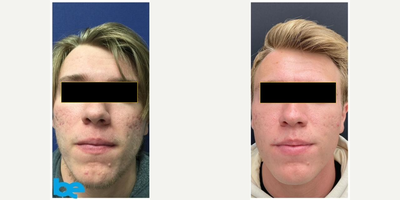 18-24 year old man treated with MiXto Laser - CO2 Laser Skin Resurfacing
