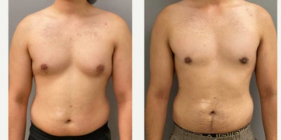 25-34 year old man treated with Gynecomastia Surgery - 27 yo s/p gynecomastia surgery with liposuction and gland excision via periareolar incision performed under local anesthesia with sedation in our on site AAAA certified operating suite.