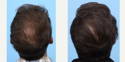 25-34 year old man treated with PRP Injections, PRP for Hair Loss, Hair Loss Treatment, FUE Hair Transplant, Hair Transplant - This patient started to notice hair loss for a few years and now is more noticeably thinning from the front to the crown. He's been wearing his hair in a longer style to cover this, but wanted a permanent solution. Dr. Wise performed an FUE hair transplant, during which he injected the patient with PRP to strengthen the follicles and expedite the healing process.