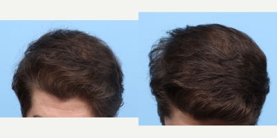 25-34 year old man treated with PRP Injections, PRP for Hair Loss, Hair Loss Treatment, FUE Hair Transplant, Hair Transplant - This patient started to notice hair loss for a few years and now is more noticeably thinning from the front to the crown. He's been wearing his hair in a longer style to cover this, but wanted a permanent solution. Dr. Wise performed an FUE hair transplant, during which he injected the patient with PRP to strengthen the follicles and expedite the healing process.