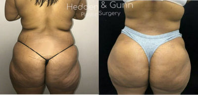 Woman treated with Brazilian Butt Lift - Woman treated with Brazilian Butt Lift and injected with1200cc into each buttock.