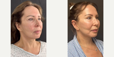 Woman treated with Brow Lift - Woman treated with Deep Plane Facelift, Neck Lift, Brow Lift, and CO2 Laser Resurfacing. Post-op, she had jawline and neck definition as well as youthful-looking brows.
