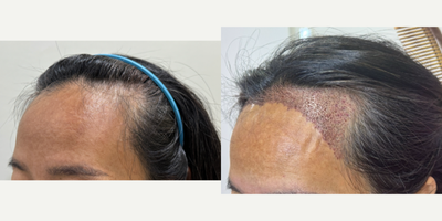 FUE hair transplant 1,700 grafts (Feminine hairline) - A middle-aged Asian woman came in for a hair transplant shaven FUE technique with 1700 grafts to lower frontal hairline and create a feminine hairline.