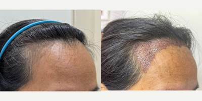 FUE hair transplant 1,700 grafts (Feminine hairline) - A middle-aged Asian woman came in for a hair transplant shaven FUE technique with 1700 grafts to lower frontal hairline and create a feminine hairline.
