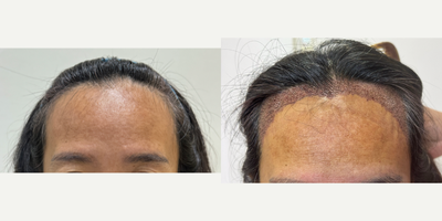 FUE hair transplant 1,700 grafts (Feminine hairline lowering) - A middle-aged Asian woman came in for a hair transplant shaven FUE technique with 1700 grafts to lower frontal hairline and create a feminine hairline.