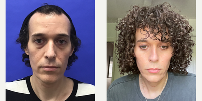 Patient treated with Cheek Augmentation - Cheek Implants (small) - 35 to 44 year-old female patient is 1 year and 1 month post-op from Facial Feminization surgery. Her procedures included: Placement of Tissue Expander for Flap with Hairline Forehead Lift and Orbital Bony Contour, Septorhinoplasty (poss. open) with Cartilage Grafts, Radix Graft and Weirs, Chin Reduction and Contour, Subnasal Lip Lift with Fat Augmentation or Fascia to Lips, Cheek Implants (small), Soft Tissue to Nasolabial Folds, and Lower Eyelid Blepharoplasty (TC) with Fat Reposition.