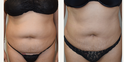 25-34 year old woman treated with Tickle Lipo - Tickle Lipo