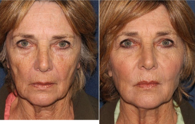 55-64 year old woman treated with Radiesse - Radiesse filler to restore lost volume to the face.