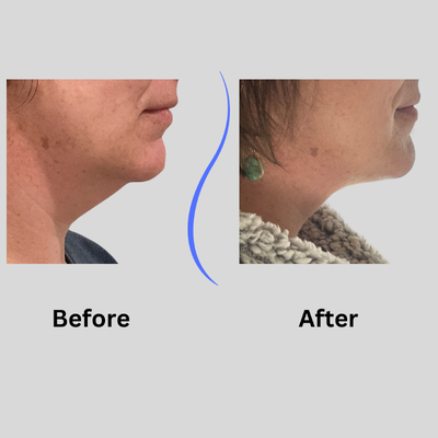 40 year old female double chin Funsculpting HD Lipo - 1 session 40 year old female double chin Funsculpting HD Lipo. No downtime. Wore compression wrap for 2 weeks. Procedure performed by Paul West PA-C.