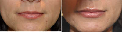 Beautiful Lips with soft Silicone implants - 
	Patients with thin or thinning lips often want a natural looking lip augmentation. In my practice, this soft silicone lip implant (surgisil) has replaced fat grafting or silicone injections. Patients are thrilled and results are permanent.

