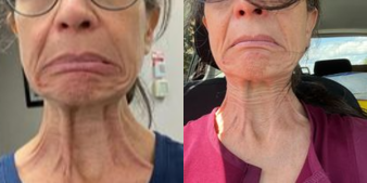 45-54 year old woman treated with Botox, Botox for Migraines - This is me, DrSimi Silver, after giving myself 5.0 units of Botox to smooth my neck.It was even better than it looks here!