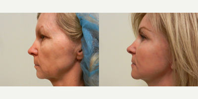 Woman treated with Laser Resurfacing - Woman treated with Deep Laser Resurfacing as well as Facelift and Endoscopic Eye Lift