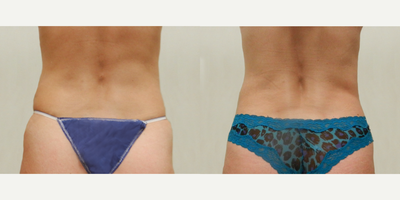 Woman treated with Liposuction - Woman treated with Liposuction to hips and flanks