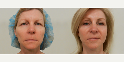 Woman treated with Laser Resurfacing - Woman treated with Deep Laser Resurfacing as well as Facelift and Endoscopic Eye Lift