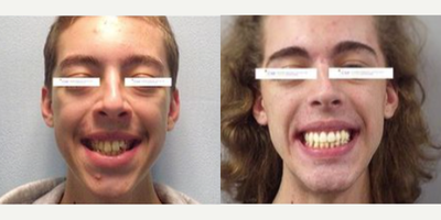 Man treated with Jaw Surgery - This patient had a skeletal reason for his teeth being out of position and rather than trying to fight nature, Dr. TImothy Osborn decided to fix both the upper and lower jaws with reconstructive jaw surgery, septoplasty, and limited access rhinoplasty. This patients aesthetic concerns were the crowded teeth, showing too much gum when he smiled, the lack of his chin prominence, and an unsupported nasal tip. To correct these, we moved the upper jaw forward and up, moved the lower jaw forward, and performed a Septoplasty, and Rhinoplasty from the underside of the nose It was a team effort, in coordination with Dr. Ella Osborn who moved his teeth to allow for a normal bite and perfect smile.Now he is a different person; not once in the 6 months leading up to his surgery did I see him smile, and at his final follow-up appointment, you couldnt get him to stop.