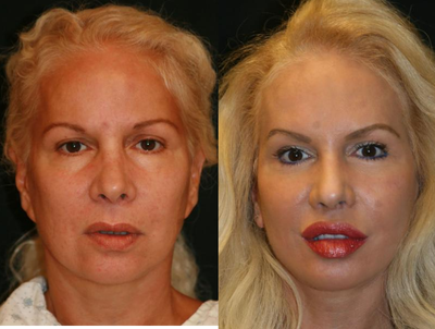 Facelift Revision - Facelift Revision