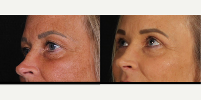 45-54 year old woman treated with Eyelid Surgery, Septoplasty - Upper blepharoplasty B&A with septoplasty.