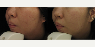 25-34 year old woman treated with Intracel - Patient did a series of 2 Intracel RF treatments
