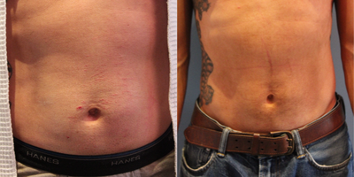 45 year old man treated with UltraShape - This 45 year old man was treated with UltraShape, a non-invasive fat elimination and body contouring treatment, to improve the appearance of his abdomen.
