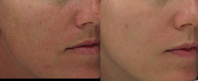 Hyperpigmentation treated with Obagi for 3 months - Facial hyperpigmentation treated with Obagi products for 3 months.&nbsp; 