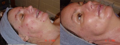 Green peel for acne treatment - Source: Omniderm&nbsp;