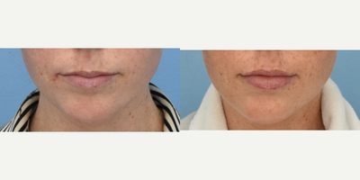 Woman treated with Restylane - Woman treated with Restylane.