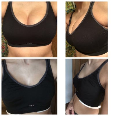 Small Breast Reduction 32DDD - Review - RealSelf