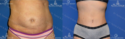 Woman treated with Liposuction Revision - Woman treated with Liposuction Revision