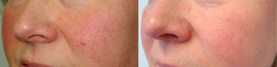 55-64 year old woman treated with Pulsed Dye Laser - 55-64 year old woman treated with Pulsed Dye Laser