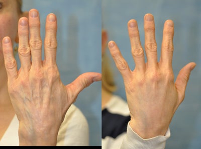 56 Year Old Female Treated for Unacceptable Cosmetic Appearance of Hands - 
	56 Year Old Female

	Diagnosis: Unacceptable Cosmetic Appearance of Hands

	Procedure: Juvederm Dermal Filler to Skin of the Back of the Hands

