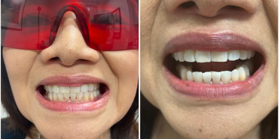 Woman treated with Smile Makeover, Teeth Whitening - One of many of our SMYLE teeth whitening patients