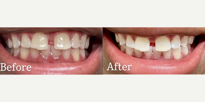 Woman treated with Teeth Whitening, Smile Makeover - SMYLE XO Teeth Whitening System provides instant stunning results everytime!!Safe & EffectiveInstant ResultsSafe for Sensitive TeethAffordablePainlessResults Guaranteed