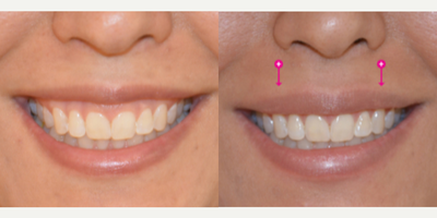 Woman treated with Botox for Gummy Smile - Woman treated with Botox for Gummy Smile