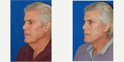 65-74 year old man treated with Deep Plane Facelift, Neck Lift - This male patient presented to us with face and neck skin laxity. He has developed deep skin folds, loss of jawline contour and extensive sagging in the neck, which all contributed to an overall aged facial appearance. A comprehensive surgical plan for this patient included a deep plane facelift and neck lift to address his concerns. The deep plane facelift and neck lift surgery helped this patient achieve an effective and natural-looking transformation. He looks more youthful and rejuvenated.