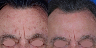 75 and up year old man treated with Chemical Peel, Laser Scar Removal, Scar Removal, Skin Rejuvenation, Laser Resurfacing, Skin  - We implemented a comprehensive combination therapy approach for a patient with an array of concerns, including multiple actinic keratosis, seborrheic keratosis, lentigines, age spots, hyperpigmentation, and skin laxity. Photos show the stunning transformation in just 3 months' time.