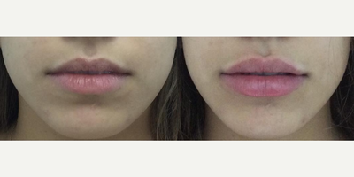Juvederm - Juvderm lip fillerPurpose: Create fuller lipsProcedure time: 20 minutes